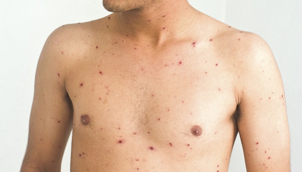 Canavese, preoccupazione per l’epidemia di morbillo. Undici i casi denunciati in Comdata a Ivrea